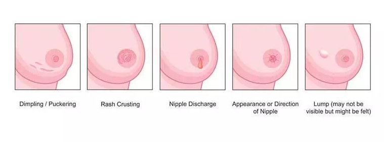 Breast changes breast cancer