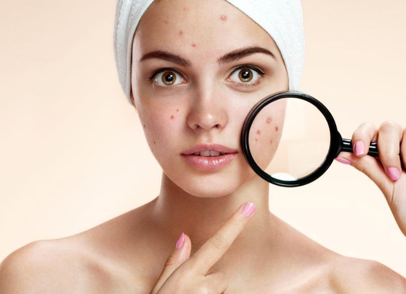 thoughts on acne treatments